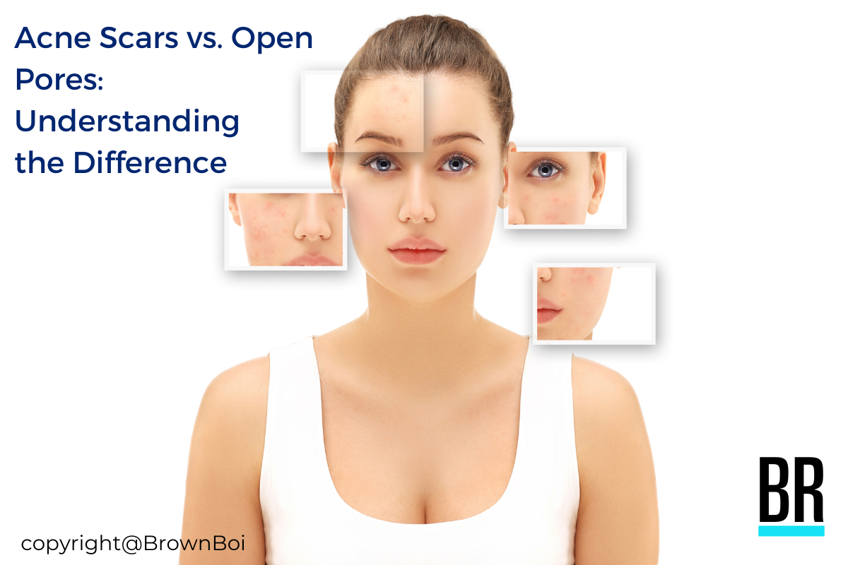 Acne-Scars-vs-open-pores